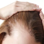 How to prevent and slow hair loss?