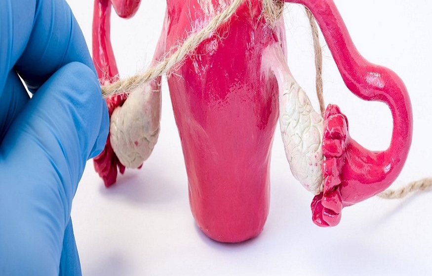 Tubal Ligation Rings vs