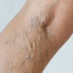 Natural Remedies for Bulging Veins: A Holistic Approach