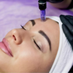 Tips for Making the Most of Microneedling