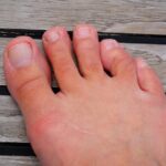 How A Podiatrist Can Help With Hammer Toe Condition