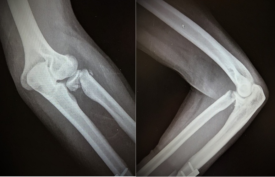 Orthopedic Surgeons In Non-Union Fractures