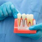 Why You Should Visit a Periodontist for Implant Success