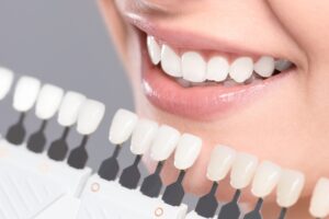 Teeth Whitening Aurora: Transform Your Smile Today